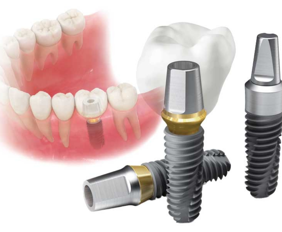 こだわりのインプラント治療
