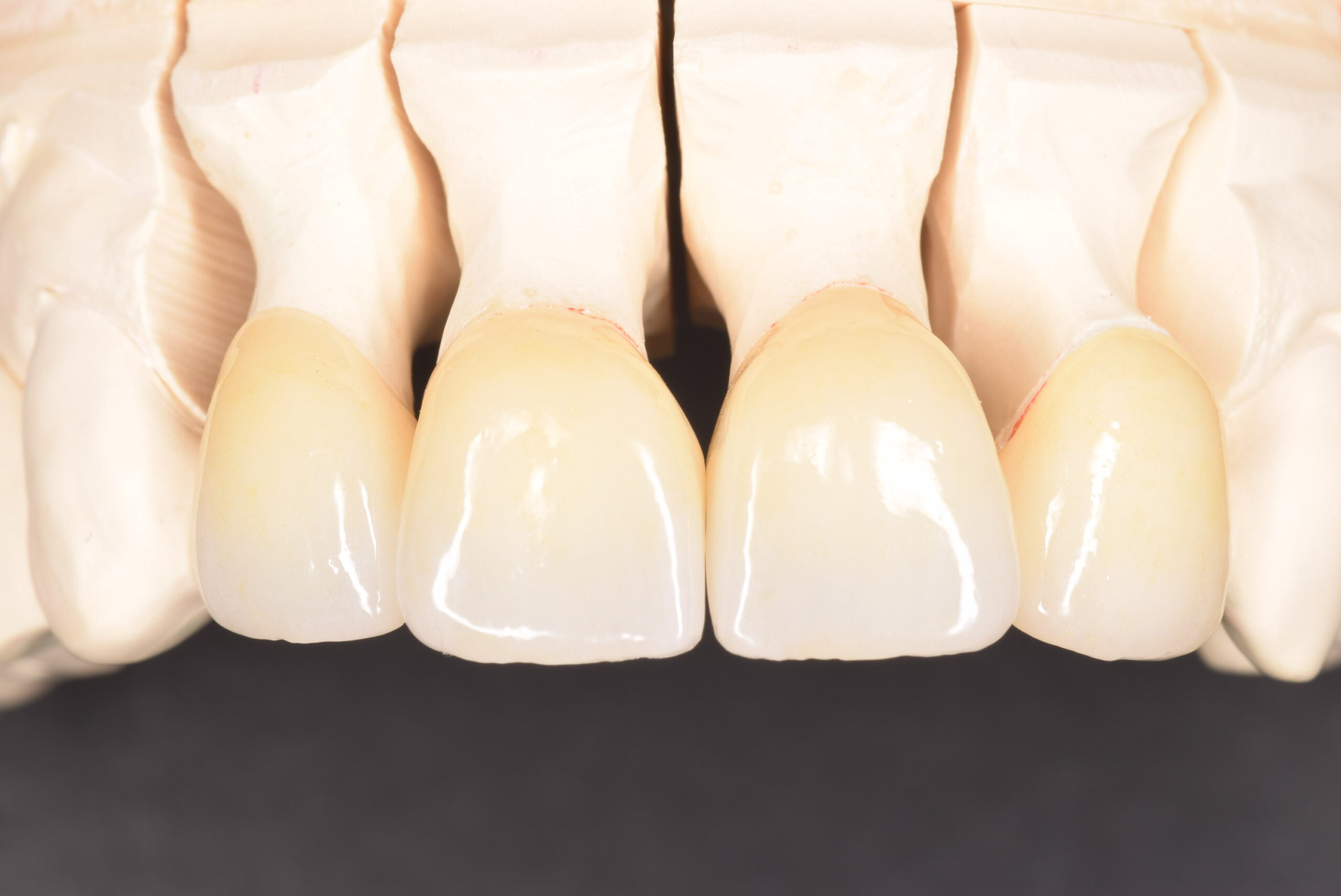 審美性の高い補綴治療