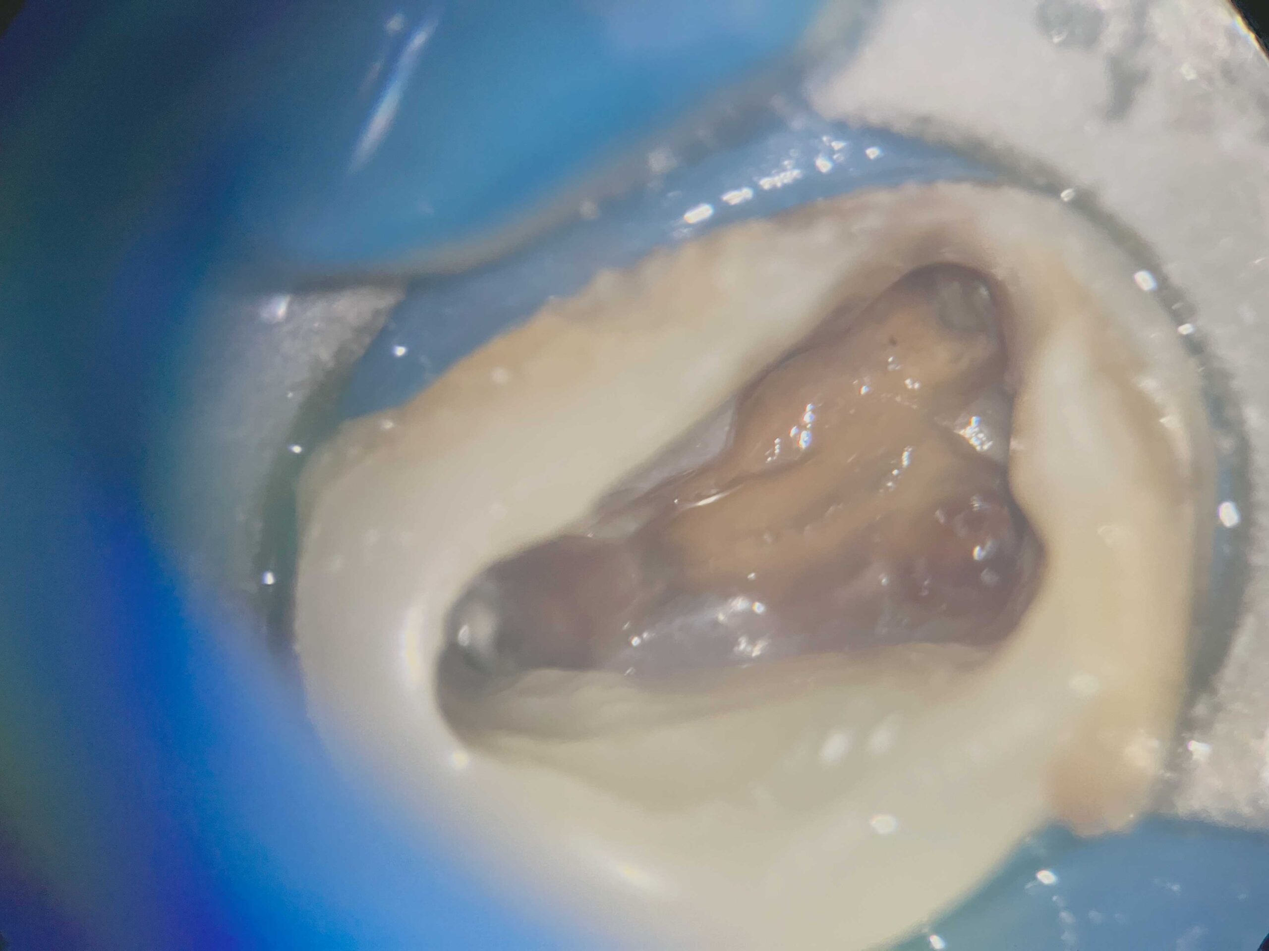 歯を残すための精密治療